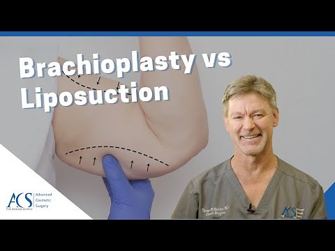 Brachioplasty (Arm Lift Surgery) Vs. Liposuction Explained By Plastic Surgeon, Dr. Tom McFadden