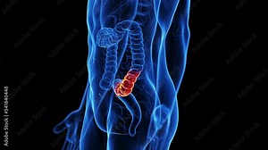 3d rendered medical animation of a man suffering from diverticulitis
