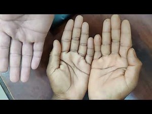 Understanding Anemia: Clinical Examination of Anemia