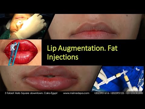 Lip Augmentation Fat Injections