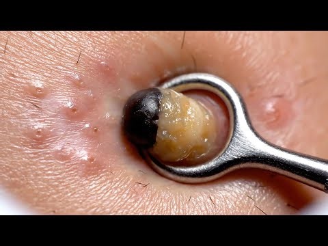 Deep Cystic Acne Extraction Spa