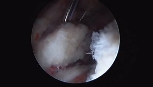 Hip Interportal Capsule Closure: Step-by-Step Technique