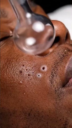 Nose Pore Unclogging — Satisfying