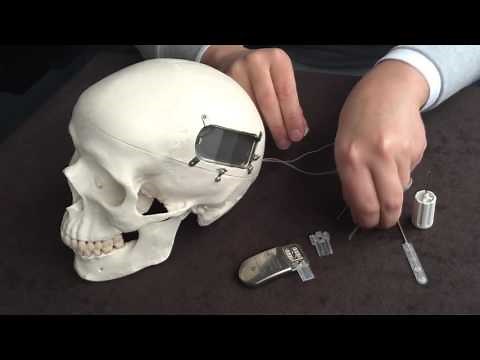 Demonstration of a NeuroPace Responsive Neurostimulation (RNS) device
