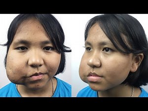 Massive Tumor Removal: Stunning 2-Year Before & After