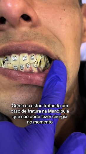Tratamento de Fratura na Mandíbula sem Cirurgia: Aparelho sem Fio e Borrachinha