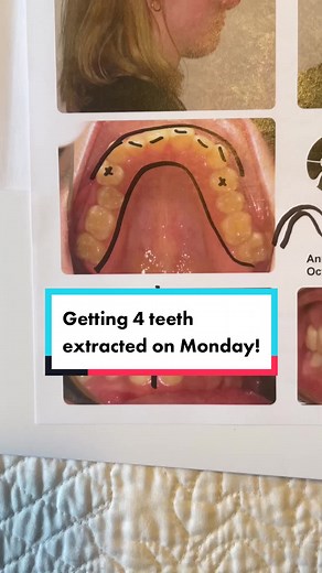 Extracting Teeth for Braces: My Journey Begins