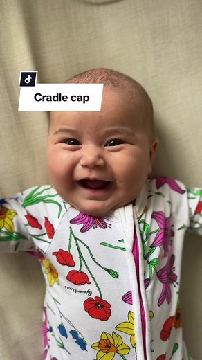 How to Get Rid of Cradle Cap: Results with MooGoo Cream