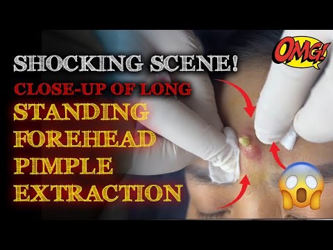 Close-Up of Long-Standing Forehead Pimple Extraction – Shocking Scene!