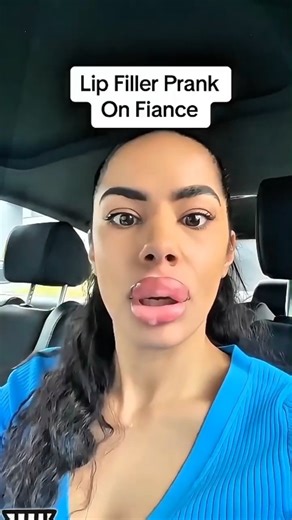 Lip Filler Prank on Bf😂