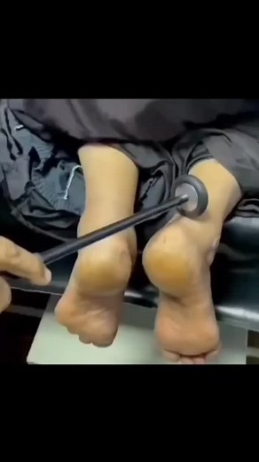 Uni Medical care on Instagram‎: "⭕علامة وولتمن (Woltman’s sign) هي واحدة من العلامات العصبية اللي بتظهر عند الأشخاص المصابين بـخمول الغدة الدرقية ( قصور الدرق ) (hypothyroidism). 🌀 لما الطبيب يفحص منعكسات الوتر العميقة (deep-tendon reflexes)، متل ما بيصير لما يضرب الركبة بالمطرقة الصغيرة، بيلاحظ إنو في تأخير بمرحلة استرخاء العضلة بعد ما تكون انقبضت. يعني، العضلة بتضل شادة شوي قبل ما ترتخي بشكل طبيعي. 🌀هالحالة مو بس بتترافق مع خمول الغدة(قصور الغدة الدرقية)، كمان ممكن تظهر مع: 💫الحمل: بسبب تغي