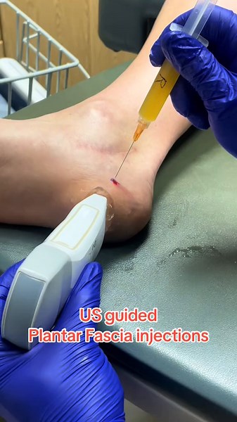 Ultrasound Guided PRP Injection of Plantar Fascia: A Detailed Procedure