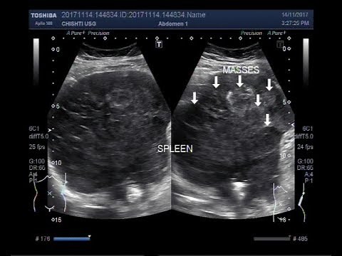 Ultrasound Video showing Hypoechoic splenic lesions.