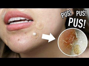 OMG HUGE ZIT OVERNIGHT REMOVAL! DID IT WORK?!