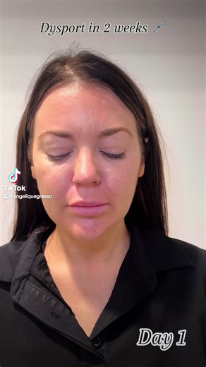 Dysport Results After 2 Weeks: What to Expect