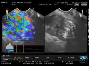 Pancreatic Cancer -- Advanced EUS Imaging: Real-Time EUS Elastography