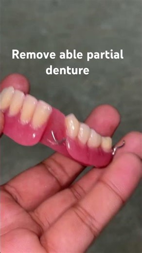 Remove able partial denture 😬😬😬#apexdental #splittooth #dentistry #partialdenture #orthodontist