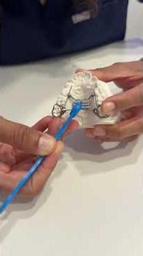 Orthodontic expanders - also called palatal expanders or maxillary expanders