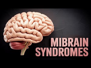 Localizing the Strokes - Part IV: Midbrain syndromes