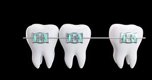 3d Video Movement Tooth Arc Locks Stock Footage Video (100% Royalty-free) 1088177069 | Shutterstock