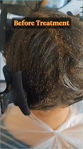 368K views · 759 reactions | This woman underwent treatment when her lice had already multiplied #Hairtreatment #Lice #Piojos #asmrvideo #asmrsound #RemovalLice #Hair | Ahmad | Facebook