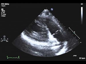 TTE Normal PLAX RV outflow Example 2