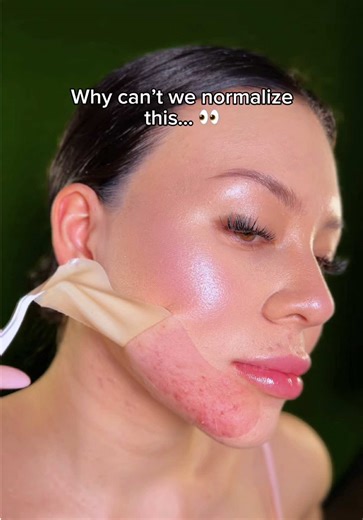 Normalizing Acne Patches in Public
