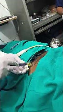 ultrasound guided Ascitic tap