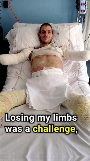 Unveiling the Astonishing World of Bionic Limbs