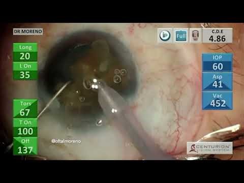 The power of phacodynamics by Dr. Jesus Moreno