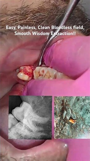 Wisdom tooth pain? 😬 It might be impacted! Don’t ignore the signs .