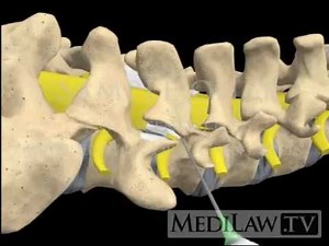 Lumbar Spine Epidural Steroid Injection Block transforaminal attorney videos