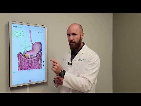 Understanding Duodenal Switch procedure with Dr. John Tann