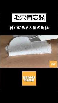 背中にある大量の角栓 #shorts #acne #blackheads #skincare #毛穴 #角栓 #美容