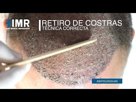 ¿Cómo quitar las costras después de un injerto/implante/trasplante capilar? | HMR Tijuana