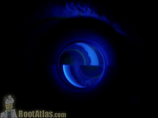 Goldman Applanation Mires for Glaucoma (Video) - TimRoot.com