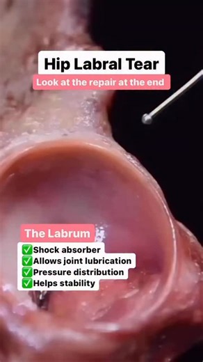 Mehmet Gem | Specialist Hip Physio on Instagram: "Great post here reposted from @chicagosportsdoc @drsafagursoy Do you know why we need to repair the hip labrum? In symptomatic patients with pain or dysfunction attributable to a tear of the labrum, retention of the labrum through a repair (if possible) is important to improve symptoms and restore joint stability. Take a look at the before and after of a hip labral repair! 🛠️💯 #fai #hipanatomy #hiparthroscopy"