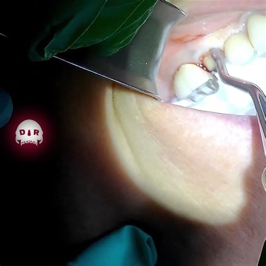 Simple Premolar Extraction using 962 Forceps, Woodson and Bernard Spade Elevators ‪@drwahan‬