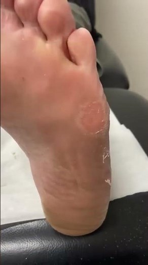 Quick & Effective Corn and Callus Removal by Australian Podiatrist | Docpods