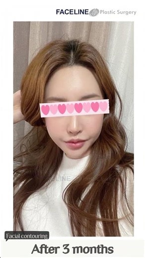 Facial Contouring Before & After #shorts