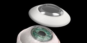 Artificial Cornea Implant Helps Legally-Blind Man Regain His Sight