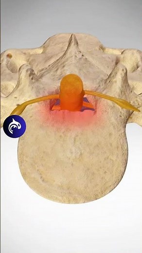 See how Lumbar Stenosis affects the Spine - 3D Animation #lumbarspinalstenosis #backpain #backpain
