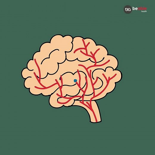Ischemic Stroke - Animation