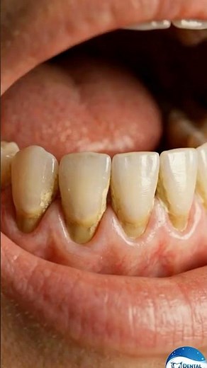 Gum Repair: Rebuilding Healthy Smiles 3d Animation #shorts