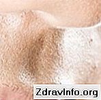 Kvapky na oči Kosopt sa používa na zníženie vnútroočného tlaku pri glaukóme. Podrobné pokyny 👃👃 Portál Sínus A Ďalšie. - 2025