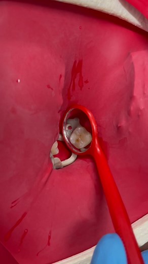 Dental Procedure: Tooth Restoration Techniques Revealed