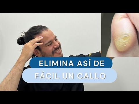 How to remove calluses and dead skin from your feet