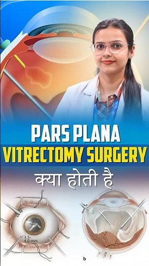 What is Pars Plana Vitrectomy Surgery? | Causes, Procedure & Cost