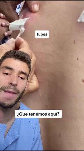 Miasis Cutánea: Infestación por Parasitos en la Piel