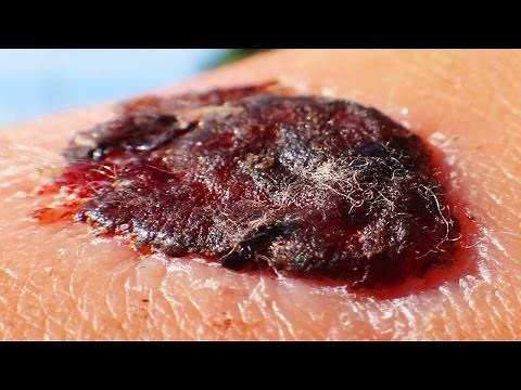 Peeling Scabs; Worst Scab Removal!